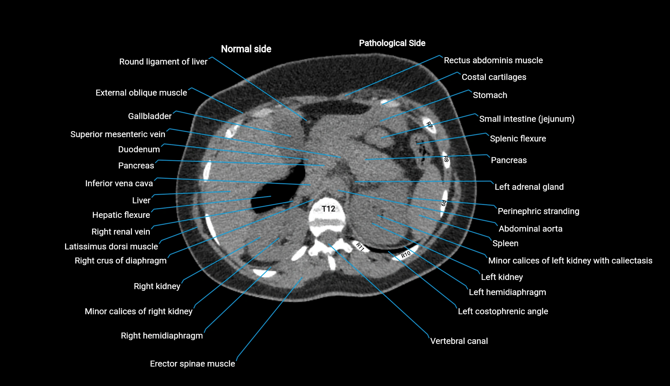 CT KUB axial cross sectional anatomy  radiology image -img-00201-00025.webp